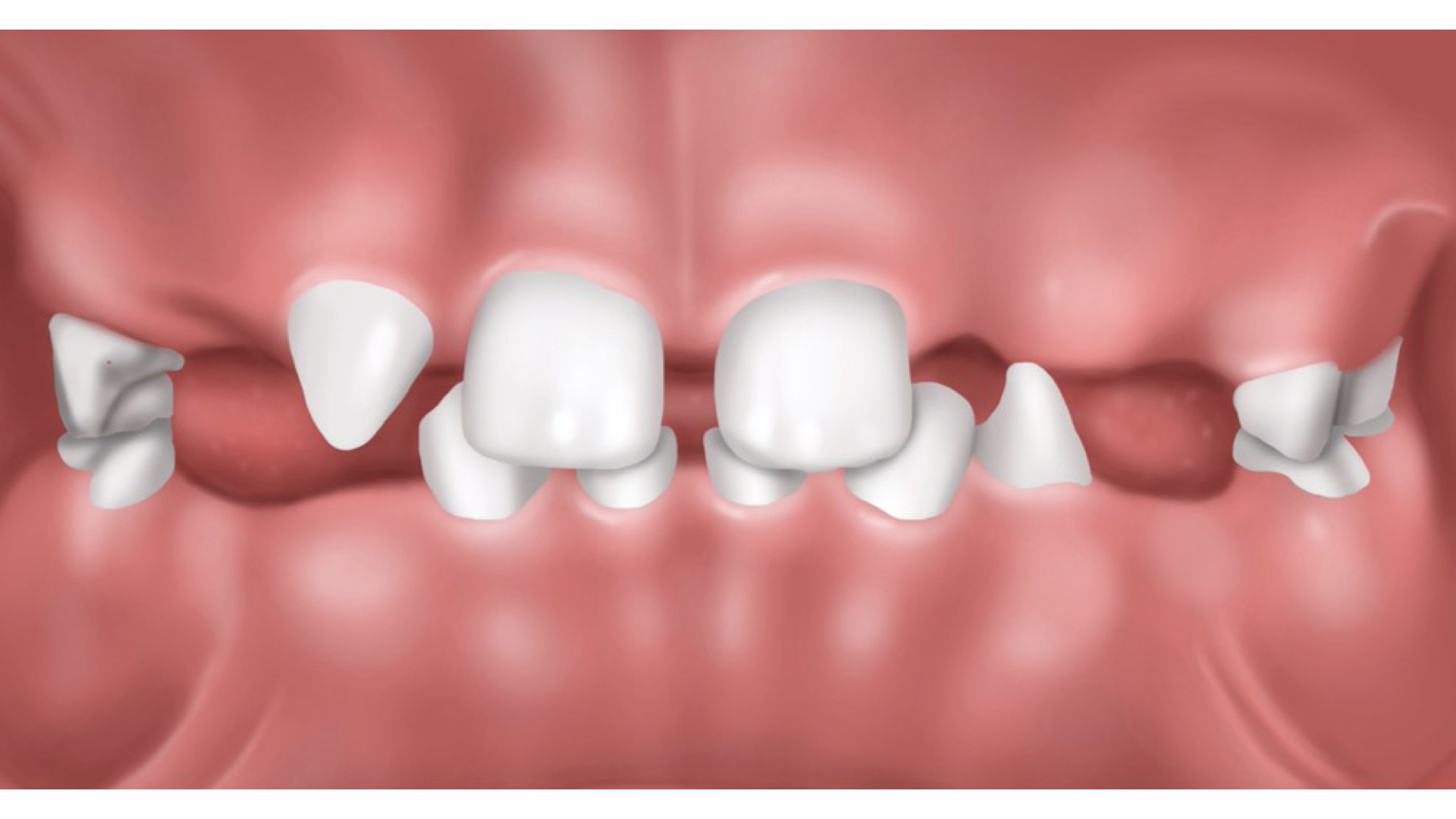 missing teeth.001 missing teeth.001